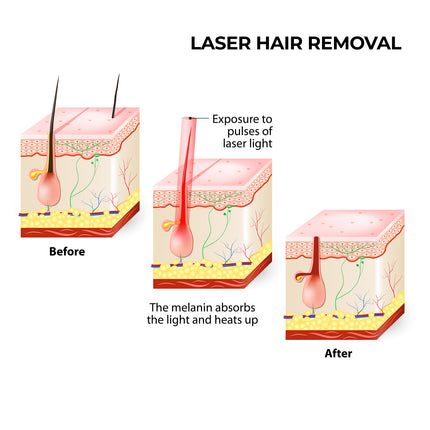 Silhouette Portable Laser Hair Remover Permanent Epliation System Body Face Home 14