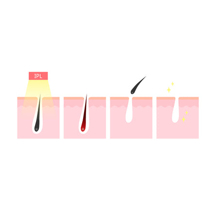 Silhouette Portable Laser Hair Remover Permanent Epliation System Body Face Home 15